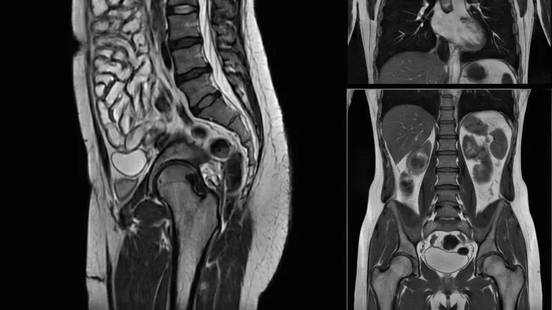ERCP، تصوير القنوات الصفراوية والبنكرياسية الراجع بالمنظار