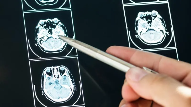 تصوير PET/CT بالدوتاتيت لأورام الغدد الصم العصبية