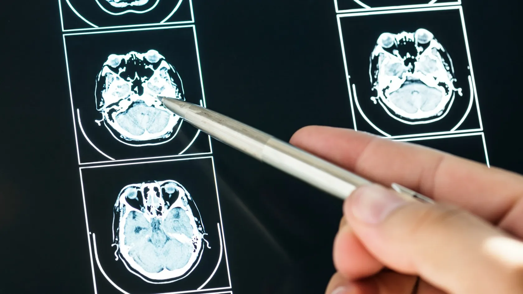 تصوير PET/CT بالدوتاتيت لأورام الغدد الصم العصبية