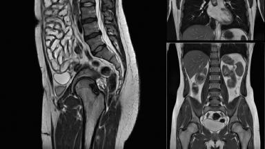 ERCP، تصوير القنوات الصفراوية والبنكرياسية الراجع بالمنظار