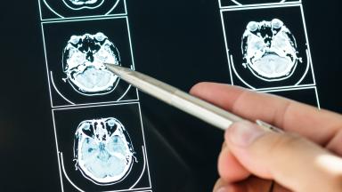 تصوير PET/CT بالدوتاتيت لأورام الغدد الصم العصبية